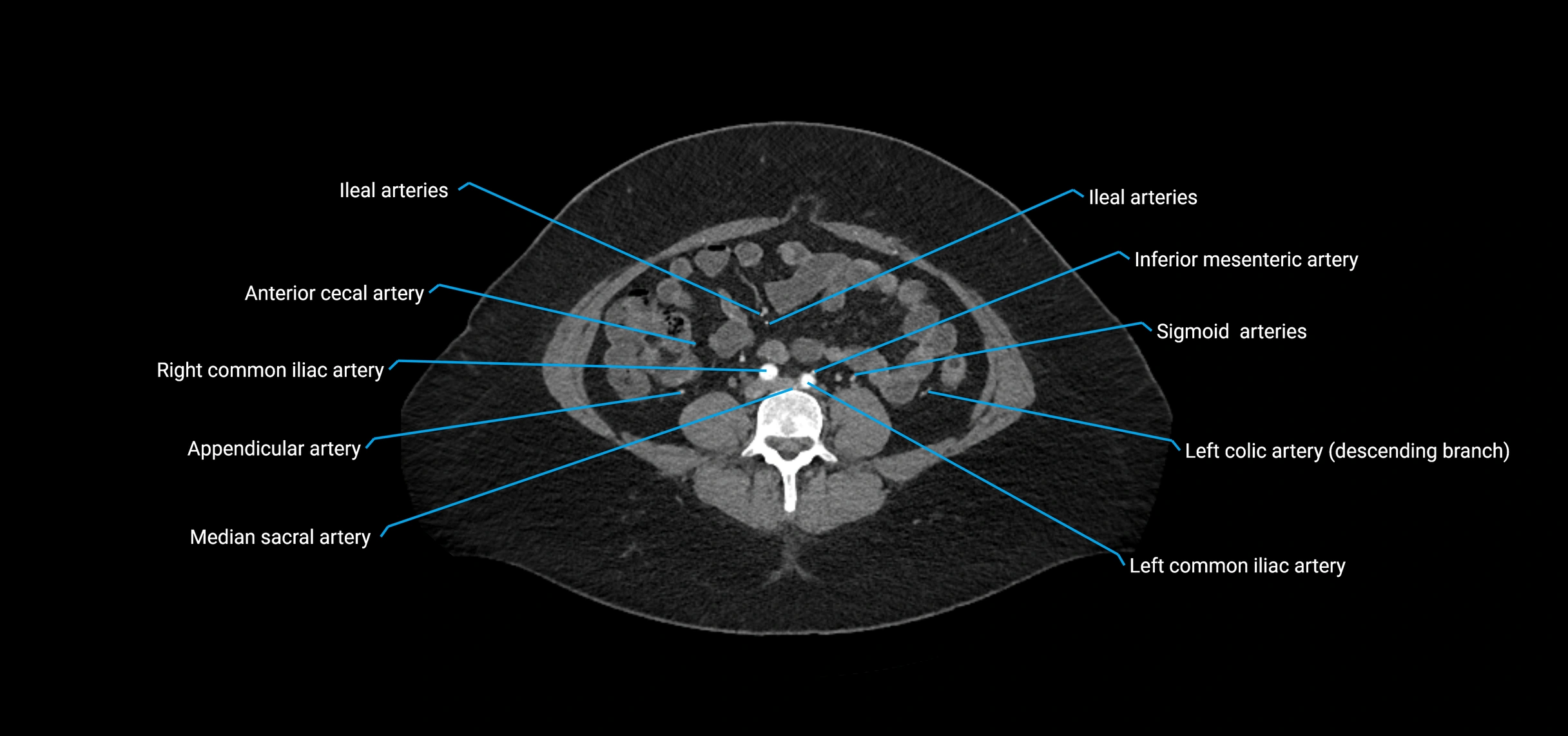 CTA abdomen axial cross sectional anatomy labelled image_143 (3).webp